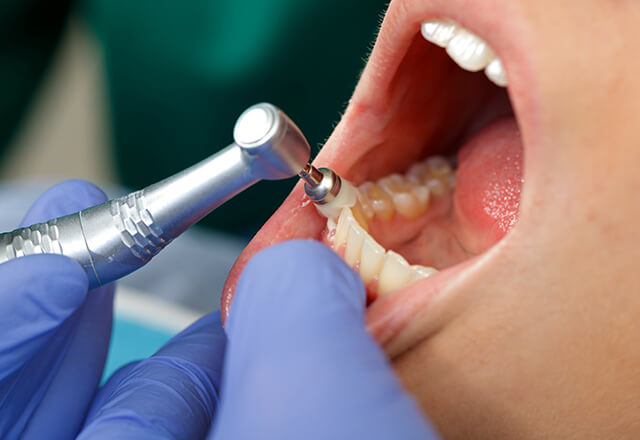 PMTC（Professional Mechanical Tooth Cleaning）